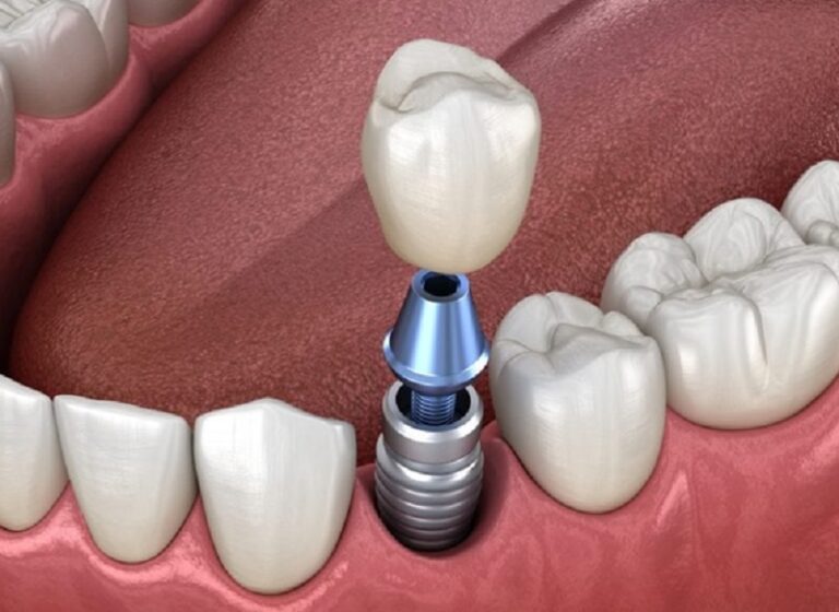 What to Expect During Your Implant Dentist Consultation in Liverpool
