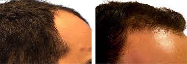Natural-Looking Results: Before and After NeoGraft Hair Transplants in Melbourne