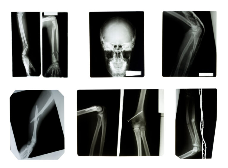 The ABCs of X-ray Interpretation: An Overview for Healthcare Professionals