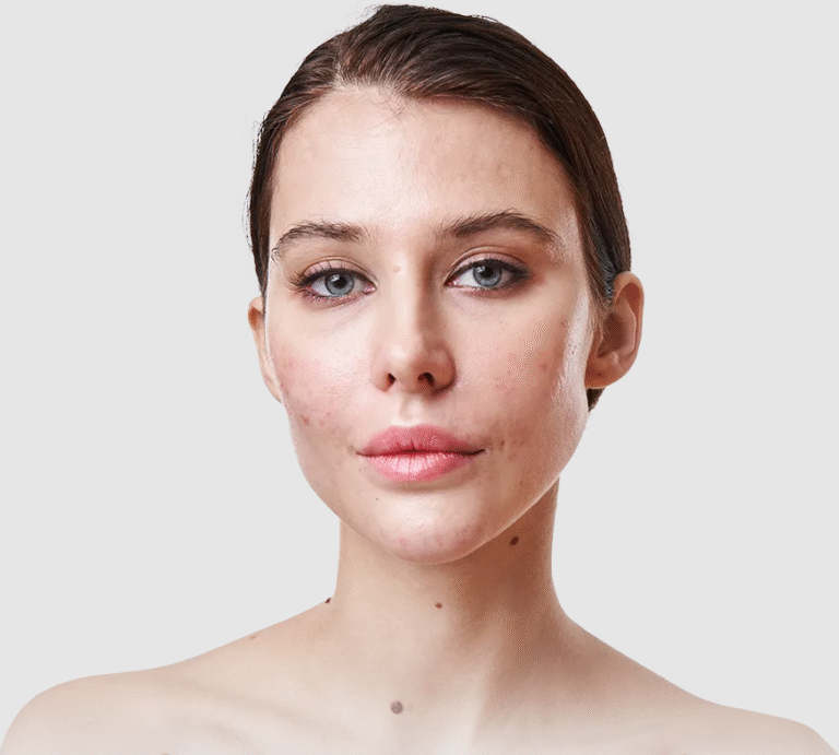Acne Scarring Treatment Options in Toronto