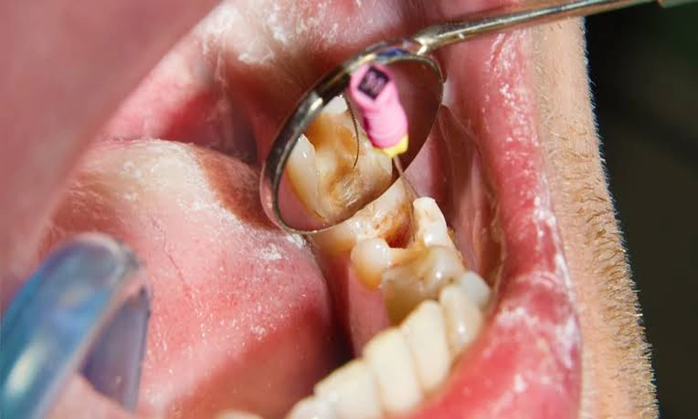 Microscopes to 3D Imaging: The Dental Technologies Transforming Precision Endodontic Treatment